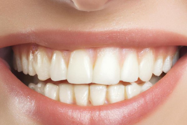 Licówki porcelanowe w Warszawie — poradnik: przebieg rodzaje i koszty  